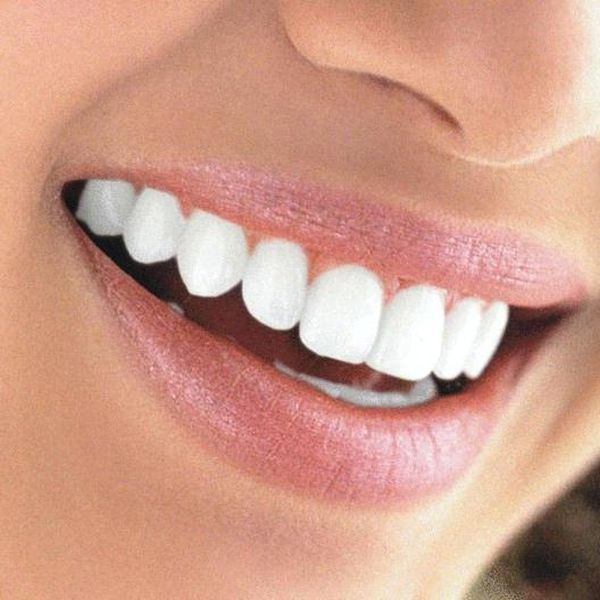 Cinco consejos para el cuidado de las carillas dentales
